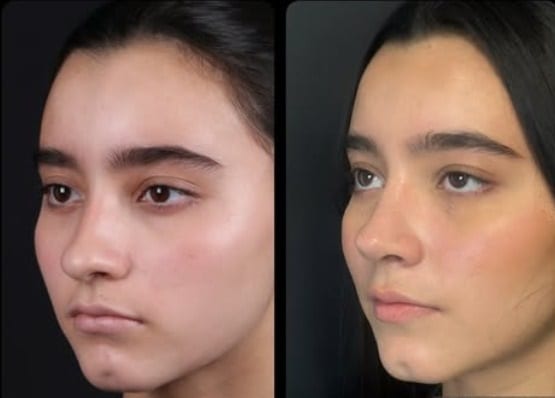 Rinoplastia caso 13 — antes y después